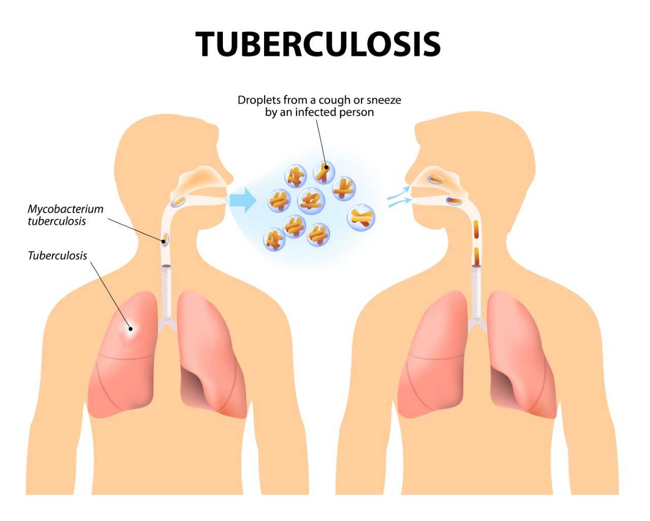 can tuberculosis travel longer distances
